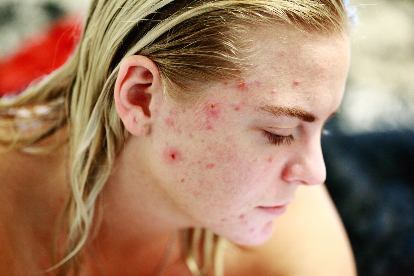 Acne tardiva: un problema per molti adulti