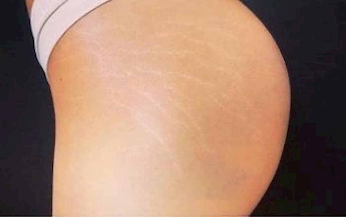 dermoabrasione cicatrici smagliature