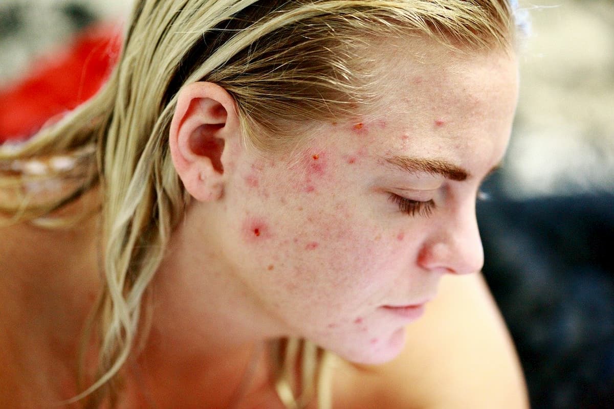 acne sottopelle